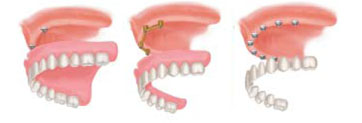 Multiple Teeth Replacements - Dental Implants