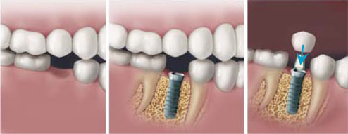 Dental Implants - Single Tooth Replacement